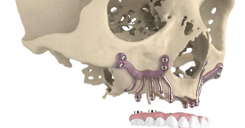Titanium implants are an alternative for patients with severe jaw bone loss (VUB).